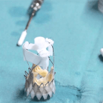A close-up of a surgical table with a heart valve prosthesis and surgical tools on a blue sterile cloth.